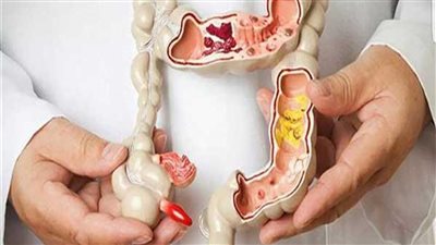 أفضل علاج للقولون العصبي.. علاجات منزلية بالأطعمة والمشروبات وأخرى دوائية