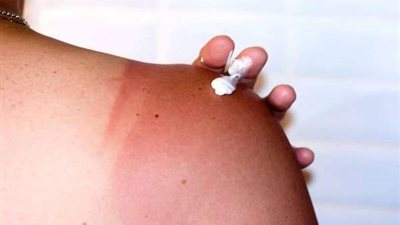 دراسة: ثلث البالغين من العالم سيتعرضون لحروق الشمس مرة واحدة على الأقل هذا العام