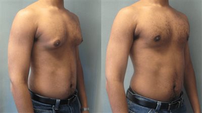 أسباب التثدي عند الرجال.. اضطراب الهرمونات أبرزها