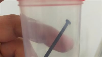 أطباء بالأقصر ينفذون طفلا ابتلع مسمارا بطول 10 سم 