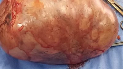 وزنهما 6 كيلو جرامات.. استئصال ورمين من مبايض فتاة بمستشفى طوخ في قنا