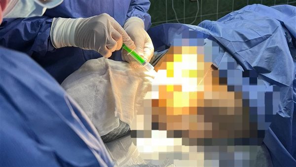 تركيب أول قسطرة مستديمة