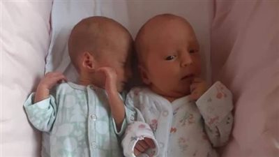 حالة نادرة.. بريطانية تلد توأمًا بينهما فارق 28 يوما في النمو