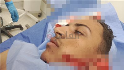 76 غرزة في الوجه وقطع بالأذن.. طالب يعتدي على زميله عقب خروجه من الامتحان بشبرا الخيمة | فيديو وصور