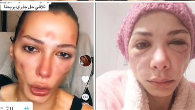 ضحية صالونات التجميل المجهولة: الدكتور قالي عندك شيطان في وشك.. وبتعالج بالقرآن والحجامة