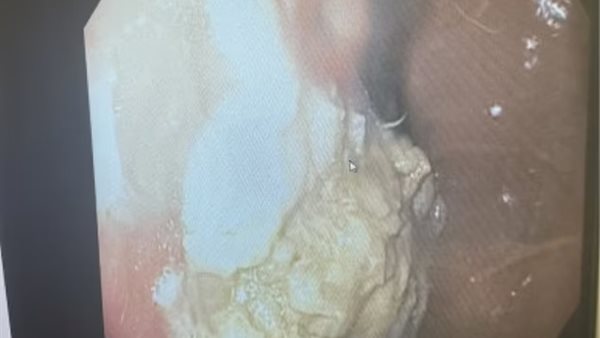 طفل ابتلع 40 علكة