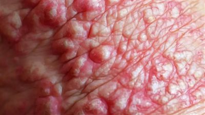 علماء يكتشفون البروتين المسبب لاضطراب جلدي وراثي نادر| دراسة 