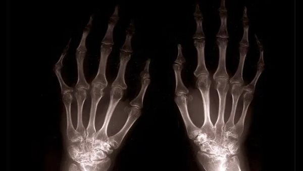 التهاب المفاصل 