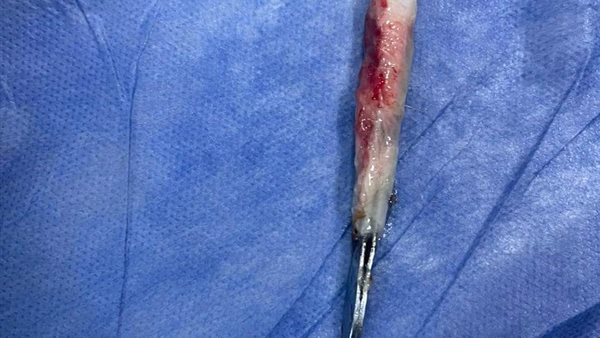 استخراج ملقاط شعر