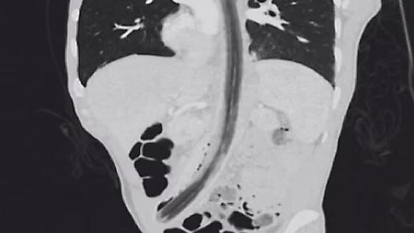 عصا في المريء
