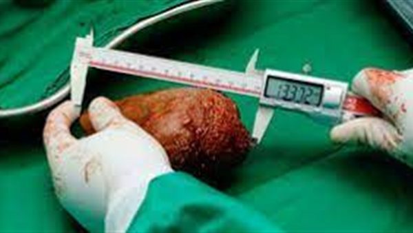 أكبر حصوة بالكلى