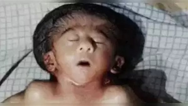 طفلة بـ 4 أذرع