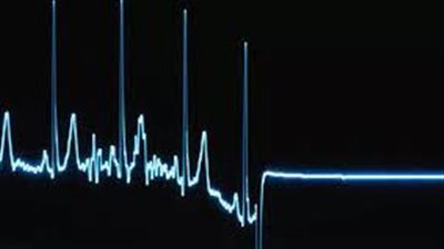 العودة إلى الحياة بعد الموت.. تعرف على متلازمة لازاروس وسبب الإصابة 