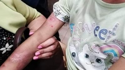 تضامن المنوفية تودع طفلة دار رعاية إثر تعرضها لحروق وتتقدم ببلاغ ضد الأسرة الكفيلة