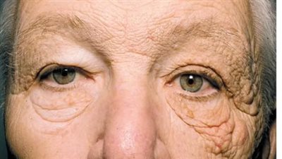 متلازمة فافر راكوشوت.. مجلة طبية تنشر صورة تظهر أضرار أشعة الشمس على الوجه