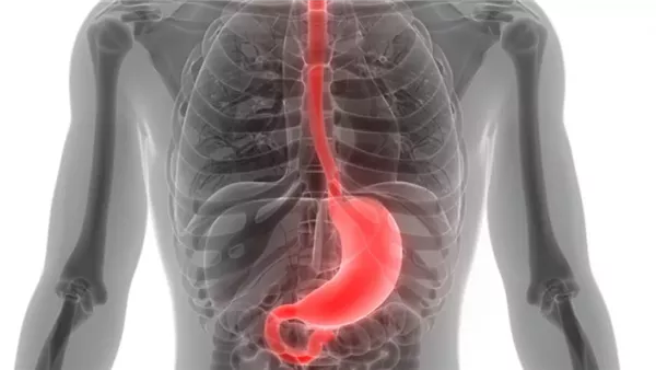 سرطان المعدة