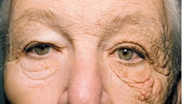 متلازمة فافر راكوشوت