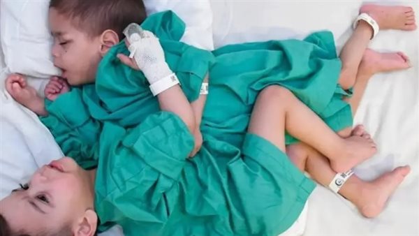 التوأم السيامي السوري