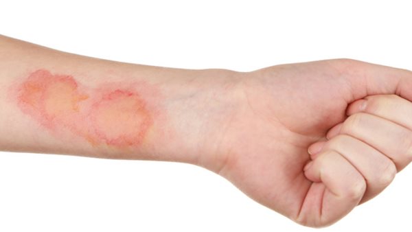 سرطان الجلد