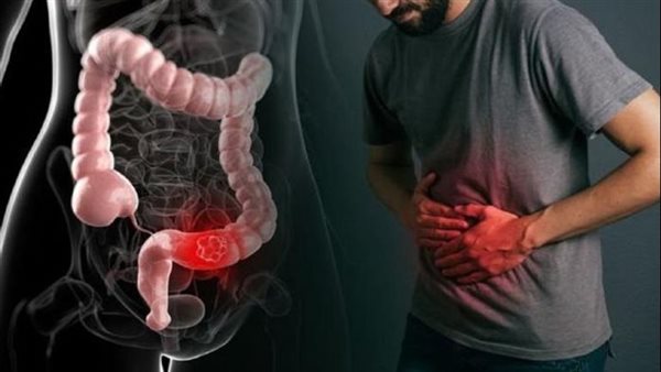 علاج الإمساك 