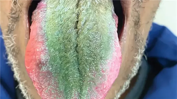 نمو شعر أخضر في لسان