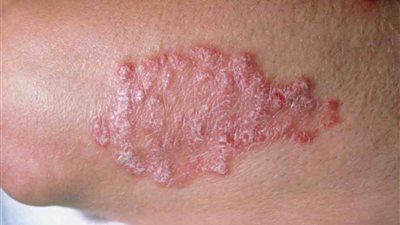 10 نصائح لمرضى الصدفية.. تعرف عليها