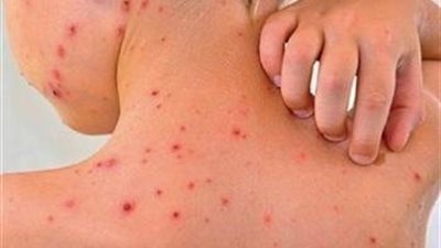 الرعاية الصحية تعلن عن علاج الصدفية بالتأمين الصحي الشامل