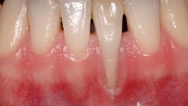 التهاب اللثة