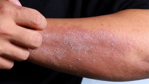 علاج حساسية الجلد