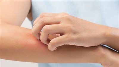 تعرف على أسباب وأعراض الإصابة بالالتهابات الفطرية في الصيف