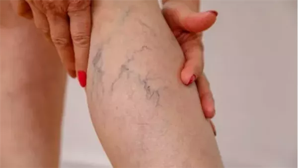 علاج الدوالي في المنزل