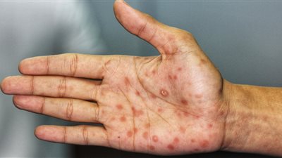 بسبب مرض منقول جنسيًا.. بلغاريا تعلن إصابة رجل بفقدان شبه كامل للبصر