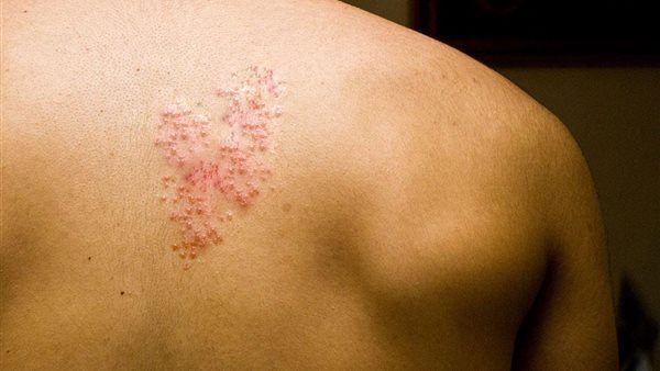 حساسية القراد 