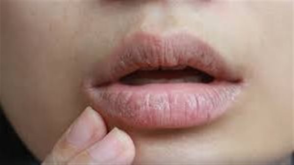 جفاف الشفاه 
