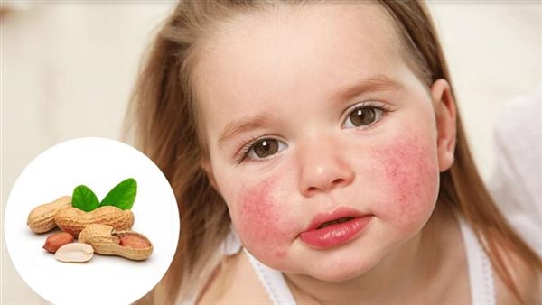 حساسية الفول السوداني