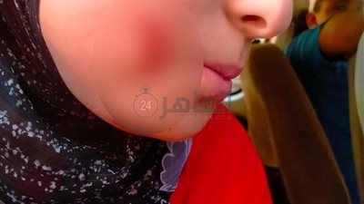 عاكسها ولما لامته عورها.. صبي يصيب فتاة بعاهة مستديمة بالمرج | صور