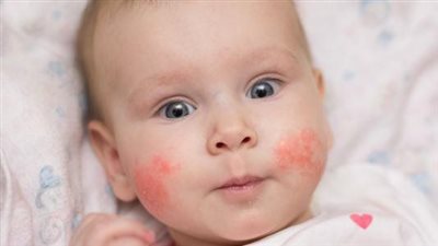 تعرف على الأمراض المصاحبة لـ حساسية الطعام