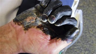 بعد ظهوره مجددا في الصين.. ما أعراض الطاعون الدبلي؟