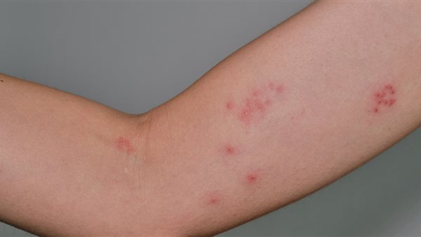 الطاعون الدبلي 