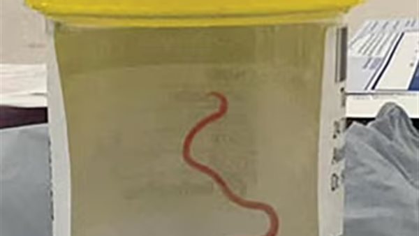 دودة اسطوانية