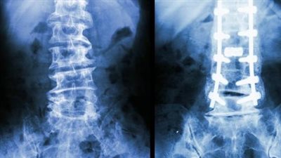 دراسة توضح أهمية الإجراءات الوقائية لتفادي كسور العظام 