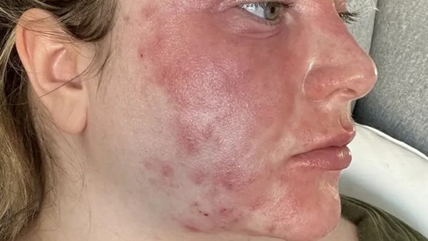 ليلي ليندساي