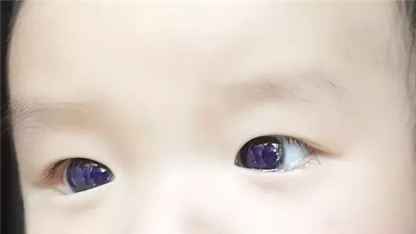 رضيع عينه تتحول للون