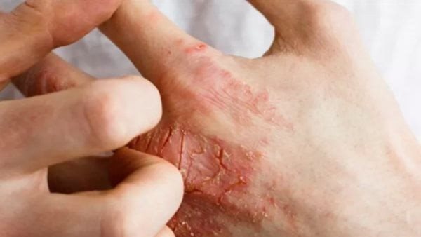 بكتيريا الجلد 