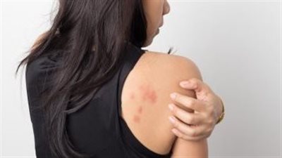 الطفح الجلدي.. أعراض الإصابة بمرض القوباء المنطقية