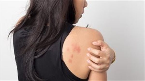  القوباء المنطقية