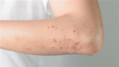 بتر الأطراف من أبرز المضاعفات.. تعرف على علامات الإصابة بمتلازمة الصدمة السامة العقدية  