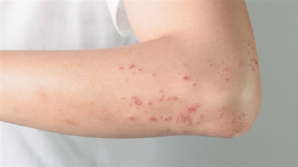 الطفح الجلدي 