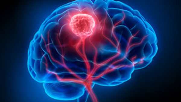 ورم بالمخ - تعبيرية