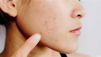 منها الصبار والكركم.. علاجات منزلية للقضاء على البثور